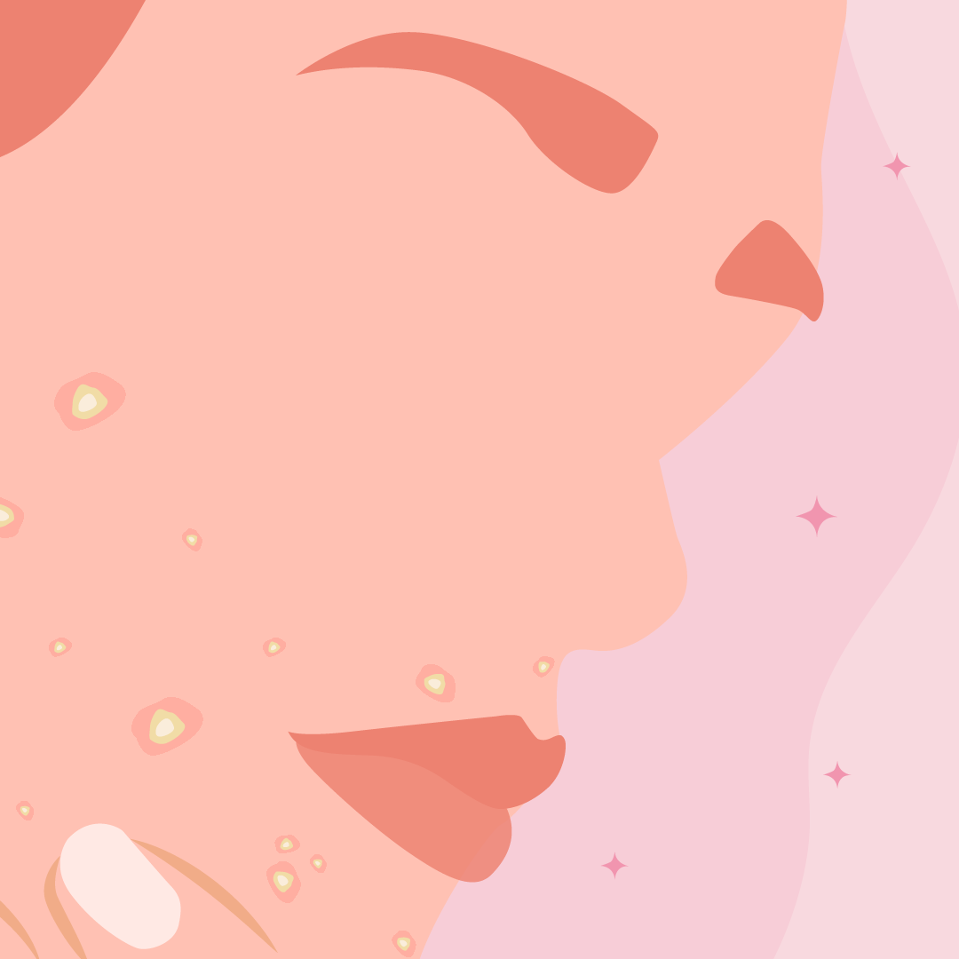 Navigating Hormonal Acne